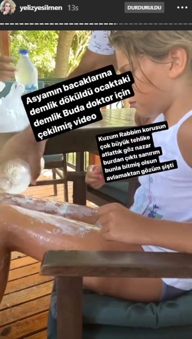 Şarkıcı Yeliz Yeşilmen'in Kızının Bacaklarına Kaynar Su Döküldü