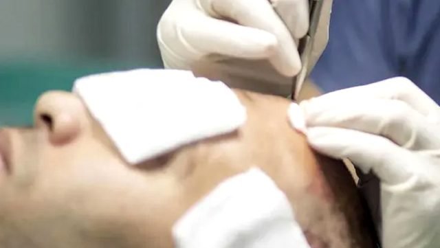 Saç Ekiminde dogru bilinen yanislar