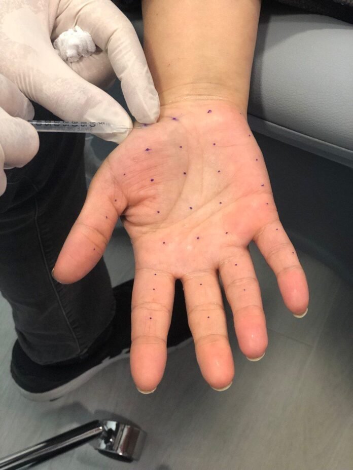 Terlemenin çözümü botoks Terlemenin çözümü botoks