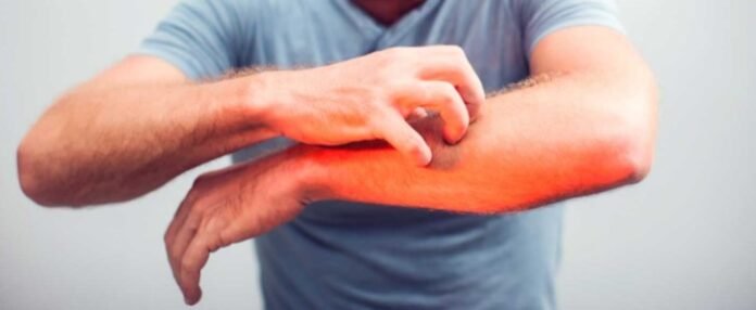 Gece uyutmayan kaşıntıların nedeni uyuz olabilir Gece uyutmayan kaşıntıların nedeni uyuz olabilir